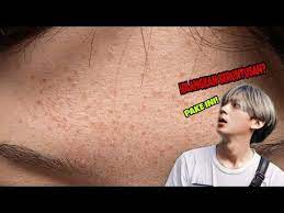 Cara Menghilangkan Jerawat Dan Bruntusan Dalam Semalam Youtube Jerawat Youtube