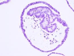 Tumor involves 1 or both ovaries with pelvic extension (below the pelvic brim) or primary peritoneal cancer. Studying The Development Of Ovarian Cancer With Organoids Eurekalert Science News