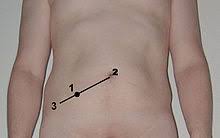 L'appendice vermiforme, appendice cecale, comunemente chiamata solo appendice è una struttura anatomica tubulare facente parte dell'intestino crasso, che appartiene al segmento prossimale noto come cieco. Appendice Vermiforme Wikipedia