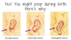 Top 10 Childbirth Fears A Series Will I Really Poop During Birth
