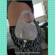 So What Is A Nephrostomy A Tube Draining Wee From Your Kidney Nice But It Helps Me And Others Like Me Stay A Kidney Surgery Surgery Recovery Working Mother