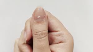 Ist Falsche Ernahrung Schuld An Weissen Flecken Auf Den Fingernageln Onmeda De