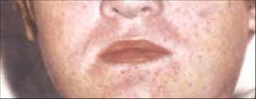 Previous marburg virus outbreaks have seen fatality rates of up to 88 per cent. Maculopapular Rash In Marburg Disease Download Scientific Diagram