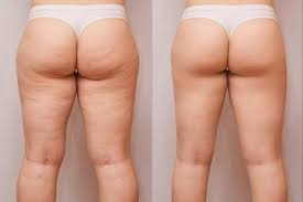 The Best Before And After HIFU Results Tyne and Wear
