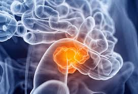 Adenocarcinoma is a malignant tumor originating in the glandular and epithelial tissue (the lining of the internal organs). Medical Detection Dogs Receives Green Light For First Ever Uk Canine Colorectal Cancer Trial Medical Detection Dogs