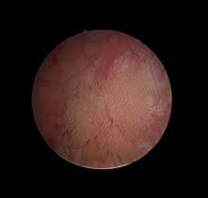 The pain may come and go at first. Bladder Cancer Genitourinary Disorders Msd Manual Professional Edition