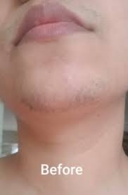 Treatment areas are upper lip, beard, chin, hairline, neckline, cheeks, and sideburns. 25 Unique Hair Removal Products