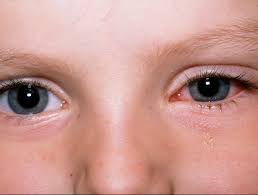 Image result for Viral Conjunctivitis