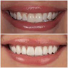 You will have to visit the dentist more than once for this type of veneer. Porcelain Dental Veneers In West Hollywood At Smile Atelier