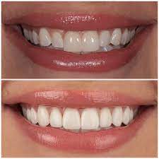 Porcelain Dental Veneers In West Hollywood At Smile Atelier