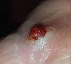 Image result for Pyogenic Granuloma