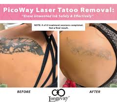 I had an old tattoo. Tattoo Removal Okc 20 Off 1 Rated Med Spa Straightforward Pricing Longevity Med Spa
