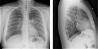 Image result for Chest XRay Interpretation