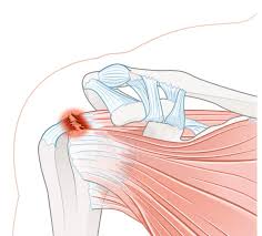 Image result for Rotator Cuff Injury