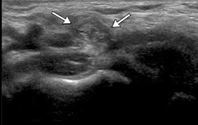 This is a custom search for the subreddit to show only videos. Us Of The Inguinal Canal Comprehensive Review Of Pathologic Processes With Ct And Mr Imaging Correlation Radiographics