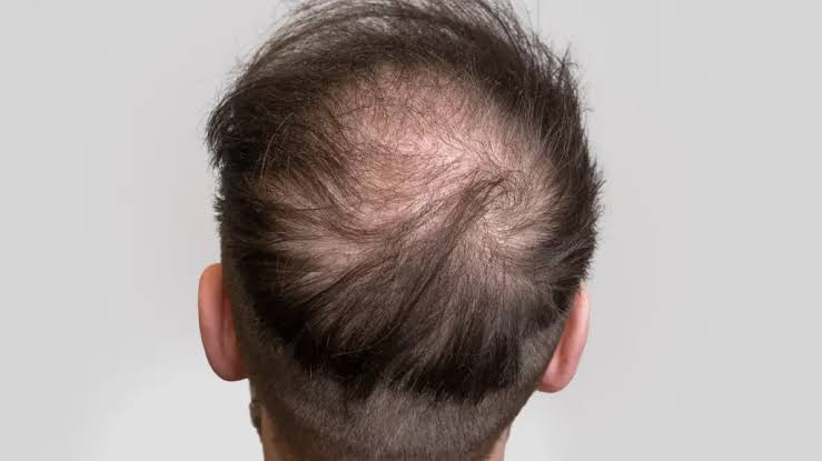 Crown Hair Transplant: A Simple Guide » Sakura MediCo.
