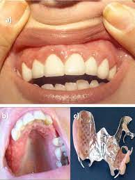 Two Cases With Nickel Induced Oral Mucosal Hyperplasia A Rare Clinical Form Of Allergic Contact Stomatitis