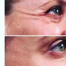 Welcome to illume aesthetics, med spa in ashland, orillume aesthetics offers intimate wellness as well as med spa services including laser treatments, . Illume Aesthetics 993 Siskiyou Blvd Ste 1 Ashland Or Medical Spas Mapquest