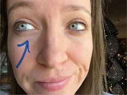 Any ideas for getting rid of bumps under eyes?