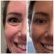 Unlock Long-Lasting Laser Results with Effective Post-Treatment Skincare  Routine