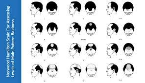 Some hair loss stories might have started as early as puberty years but you might have failed to notice them. Baldness The Early Signs And Prevention