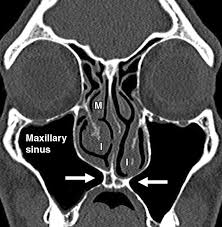 Image result for Sinus CT