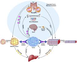 Image result for Cachexia in Cancer