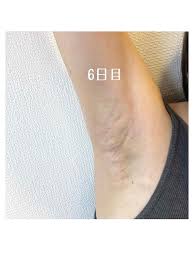 症例写真 ミラドライ 経過６日目 肌と歯のクリニック 千葉 美容皮膚科