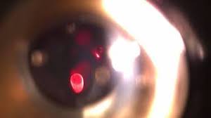 Yag Kapsulotomie Nachstar Institut Fur Augenheilkunde