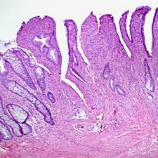 Pathology showing eroded hyperplastic mucosa with fibromuscularization...
