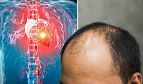 Bald men had higher rates of coronary heart disease than those with hair. Heart Attack Symptoms Signs You Re At Risk Include Hair Loss Express Co Uk