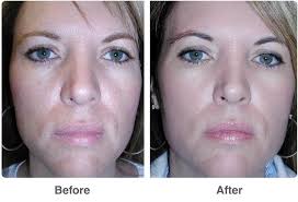 Pin On Skin Chemical Peels