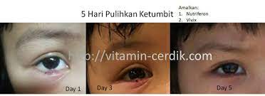 Baca cara menghilangkan iklan di xiaomi ini, dijamin iklan hilang selamanya! Cara Hilangkan Ketumbit Jom Hidup Sihat