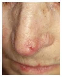 These small bumps appear when the hair follicle swells up because it's been infected by yeast or bacteria. A Bcc Involving The Lateral Tip Of The Nose B Zitelli S Flap Download Scientific Diagram