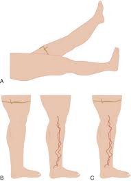 Image result for Perthes Test