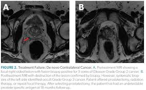 Recurrent prostate cancer is more common than you may think. Management Of Recurrent Prostate Cancer After Focal Therapy