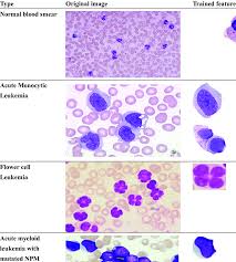 Treatment for leukemia can be complex — depending on the type of leukemia and other factors. Types Of Leukemia And Normal Studied And The Trained Features Extracted Download Table