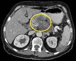 Check spelling or type a new query. Pancreatic Cancer Ct Wikidoc