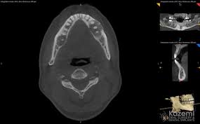 (a) multiple confluent opacities in all four jaw quadrants. Cemento Osseous Dysplasia Of The Jaw Bone Cemento Osseous Dysplasia Of The Jaw Bone Kazemi Oral Surgery Facialart Com
