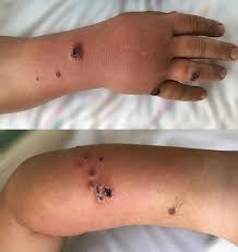 Anthrax, causes, symptoms, diagnosis, tests, treatment & prognosis