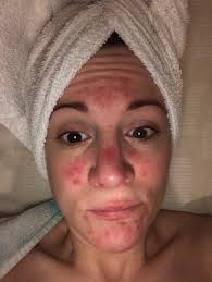 How can i prevent it in the future? 11 People Describe What It S Really Like To Have Rosacea Self