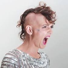 This can be effective, especially for people with milder forms of the disease (less than 50% hair. Lady Alopecia Female Baldness Blogger Proud Bald Women Ladyalopecia Profile Pinterest