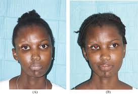 Autologous adipose tissue transfer in progressive hemifacial atrophy: From  simple volume to regenerative cell therapy