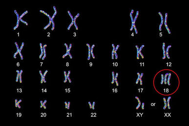 Karyotype Showing Trisomy 18, AI generated