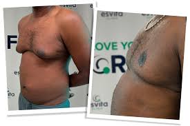 Image result for Gynecomastia