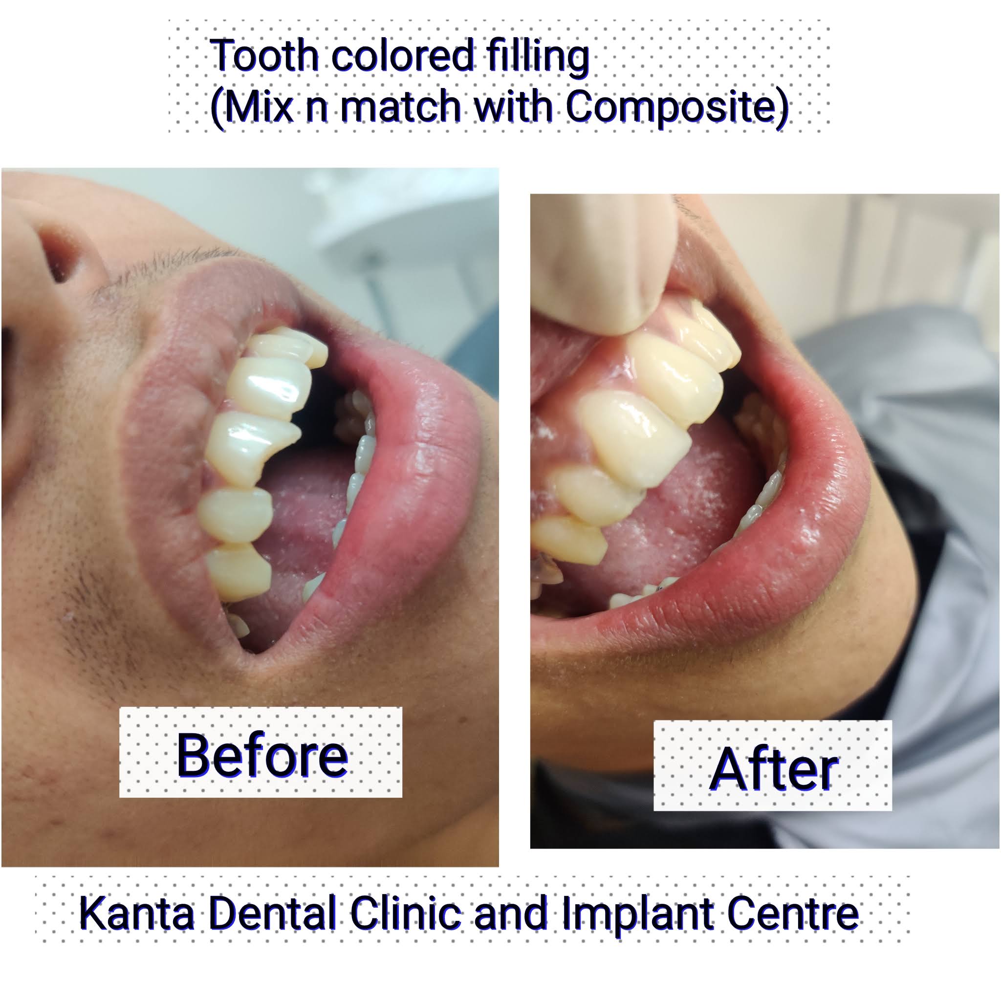 Teeth colored filling (Composite\laser filling) product image