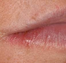 Oral herpes symptoms start as an itch and tingle before a blister appears. Mild Herpes Photos The Hsv Blog