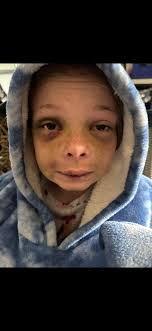 Oh this girl!!! She was playing in her brother's room with a drone when one  of his souvenir bowling pins from one of his birthday parties fell and hit  her in the