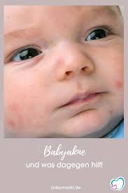 Babyakne Was Tun Gegen Ausschlag Bei Babys Babyakne Akne Baby Pickel