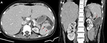 Image result for Splenic Abscess